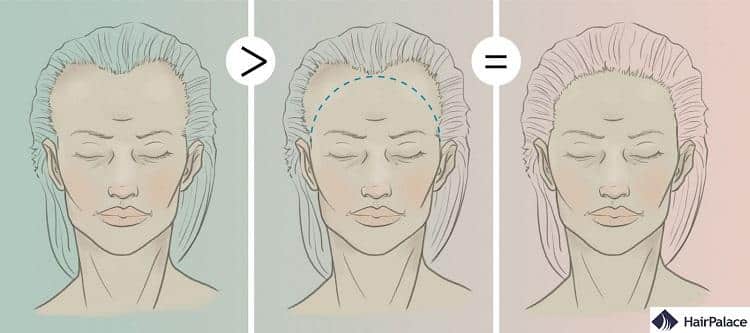 mtf hair transplant before and after